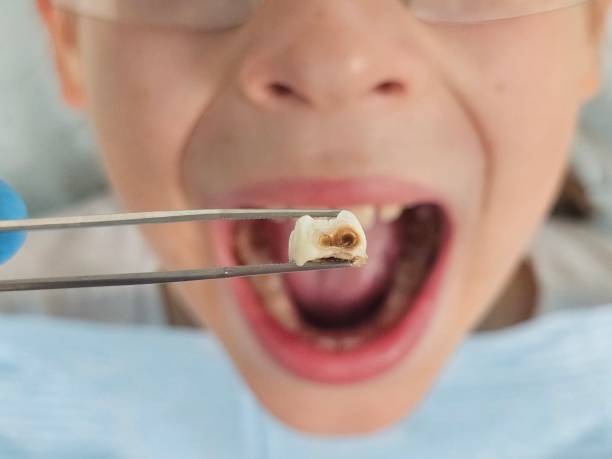 Best Emergency Root Canal Treatment in Castle Point, MO