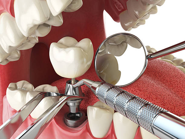 Best Emergency Wisdom Teeth Removal in Castle Point, MO